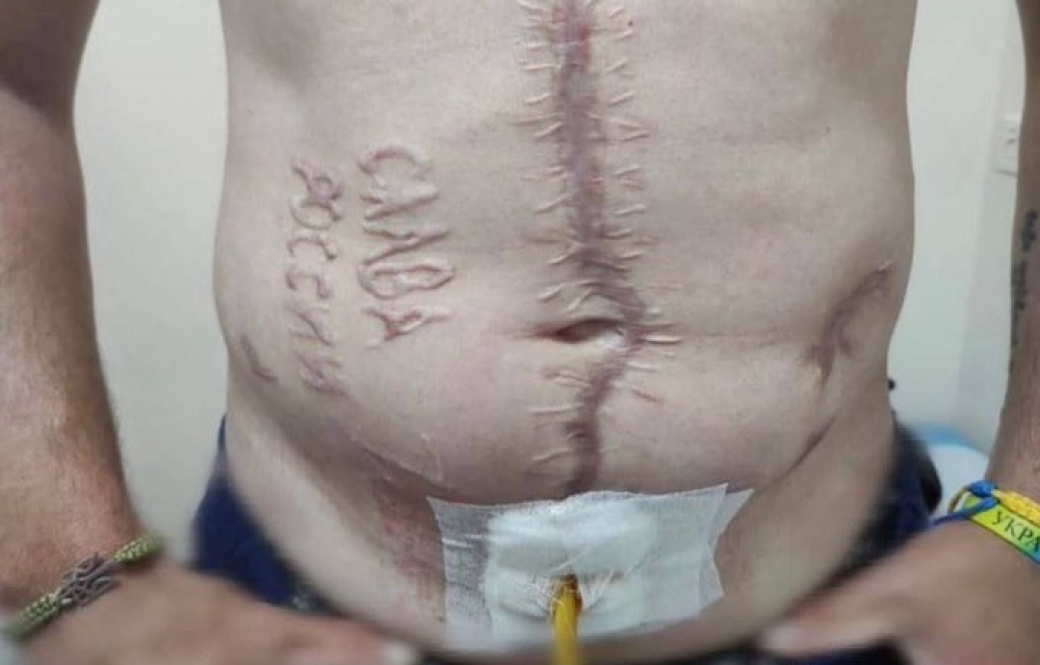 Na těle vypálený nápis. Šokovaný lékař zveřejnil fotku vojáka, který se vrátil z ruského zajetí