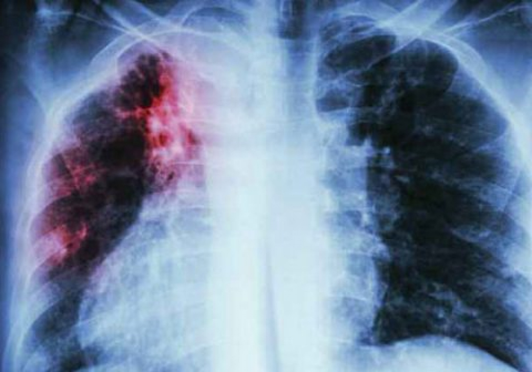 Zlínský kraj patří dlouhodobě k regionům s nejnižším výskytem tuberkulózy v ČR