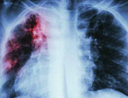 Zlínský kraj patří dlouhodobě k regionům s nejnižším výskytem tuberkulózy v ČR